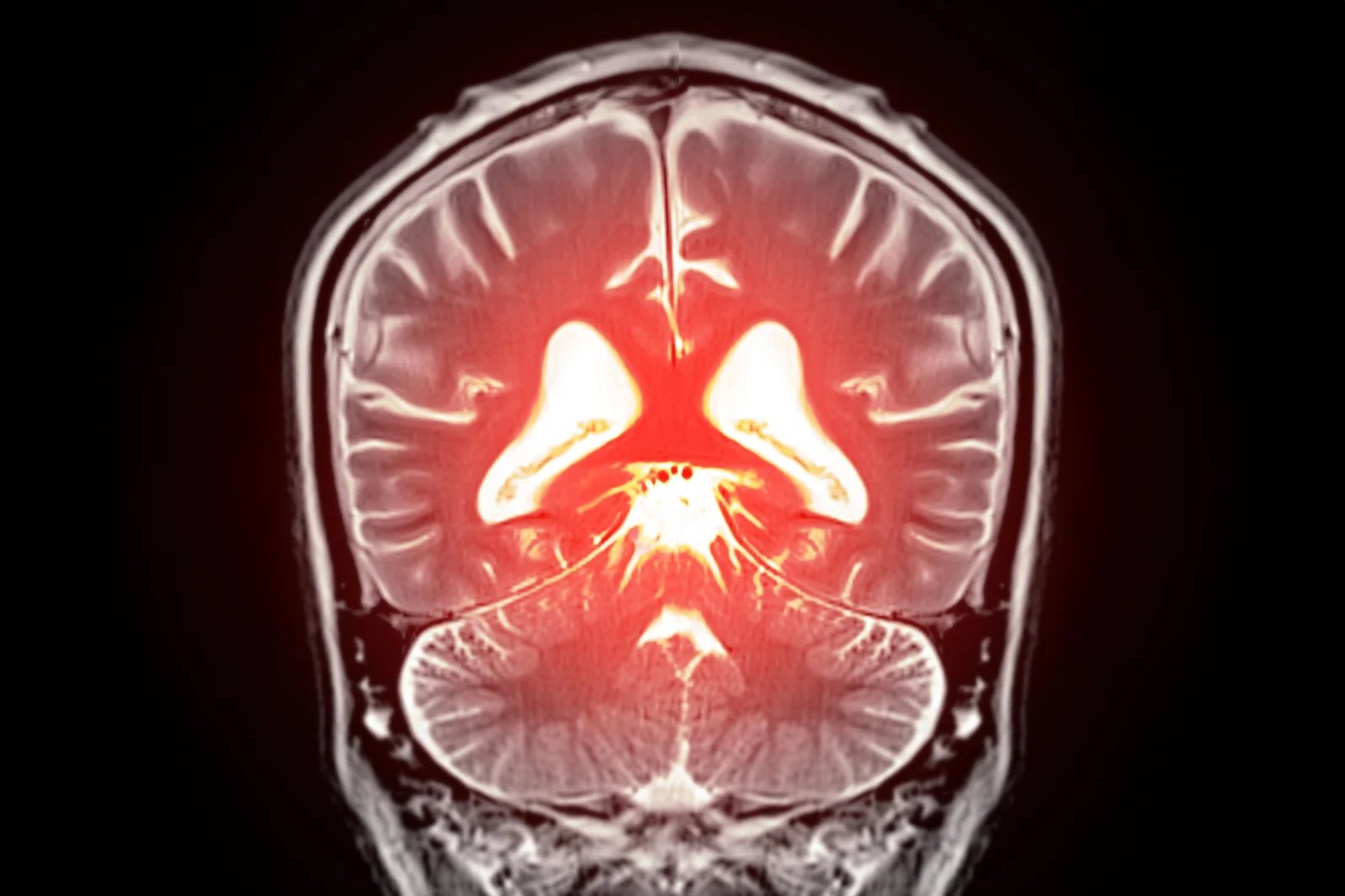 جزيء دماغي مفقود قد يكون السبب وراء الإصابة بالخرف الوعائي 3 1766441697 جزيء دماغي مفقود قد يكون السبب وراء الإصابة بالخرف الوعائي
